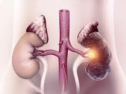 Tecnología renal avanzada